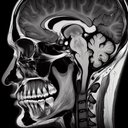 МРТ скронево-нижньощелепного суглоба