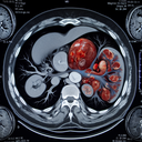 МРТ селезінки